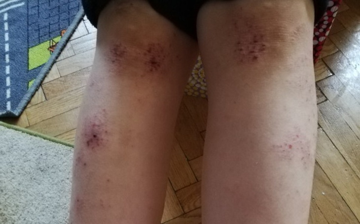 Zbiórka Zakup leków dla syna  AZSiAlergi - zdjęcie główne