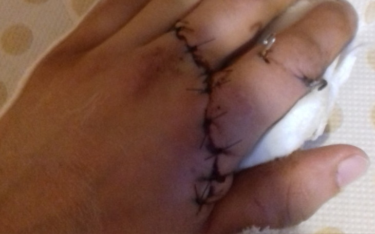 Zbiórka Proteza stawu palca - zdjęcie główne