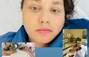 Zbiórka WZW C Przeszczep wątroby - miniaturka zdjęcia