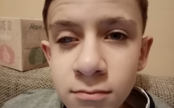 Zbiórka Przeszczep implantu gałki ocznej - zdjęcie główne