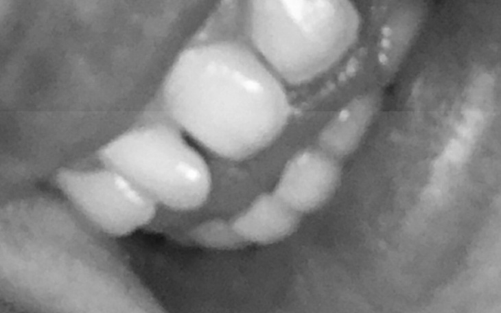 Zbiórka ZbiórkaA na aparat na zęby - zdjęcie główne