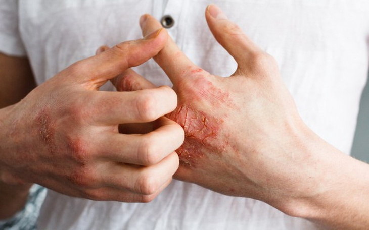 Zbiórka Na leczenie skóry Adrian - zdjęcie główne