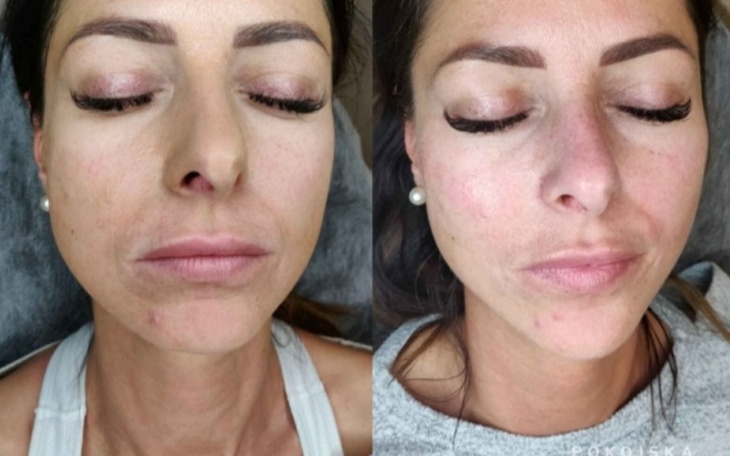 Zbiórka Volometria twarzy i inne zabiegi - zdjęcie główne