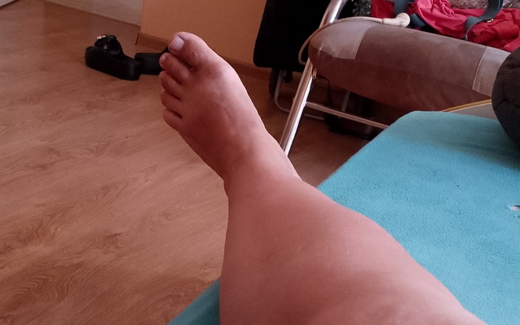 Zbiórka Operacja kolana łękotki - zdjęcie główne