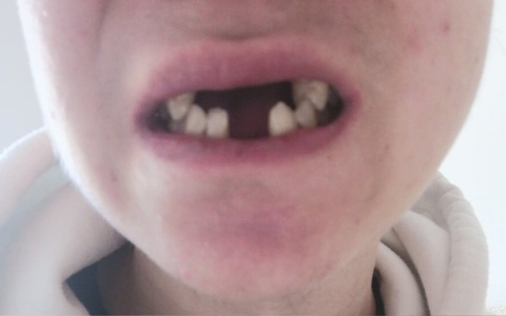 Zbiórka Implanty  na zęby - zdjęcie główne