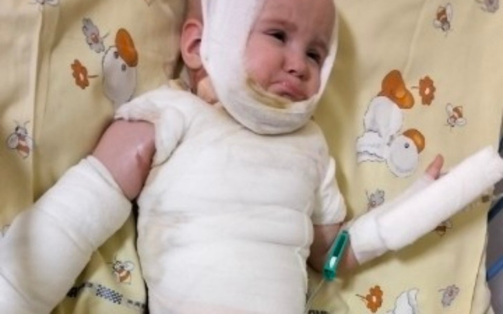 Małe dziecko w szpitalu, z opatrunkami na ciele i smutnym wyrazem twarzy.