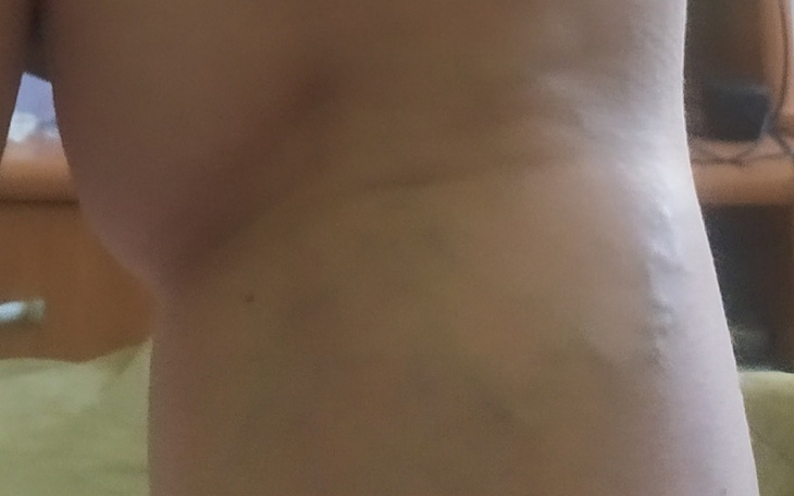 Zbiórka Zabieg laserowy usunięcia żylakó - zdjęcie główne