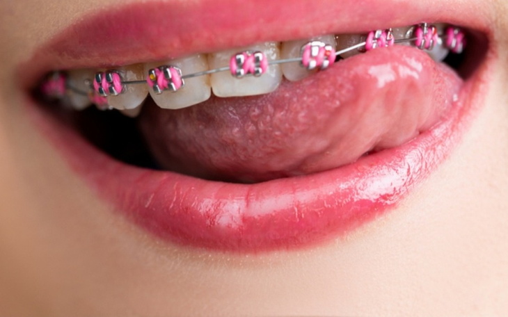 Zbiórka Jeden łuk aparatu - zdjęcie główne