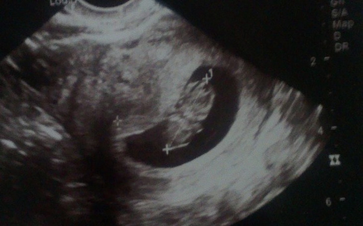 Zbiórka Wózek dla córeczki - zdjęcie główne