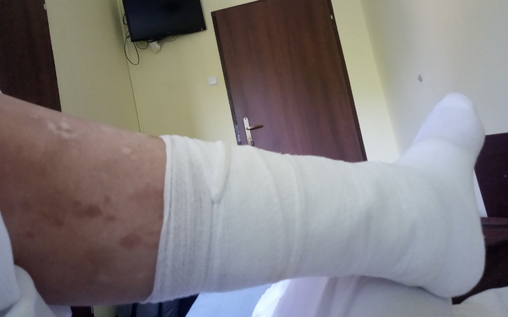 Zabandażowana noga w szpitalnym otoczeniu.