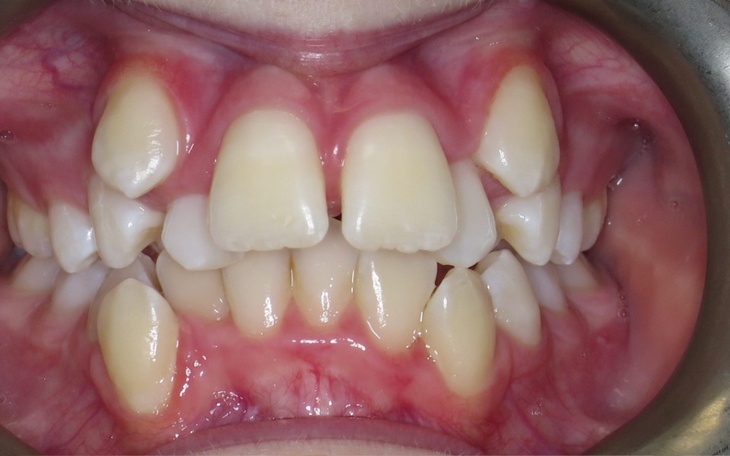 Zbiórka Leczenie zgryzu - zdjęcie główne