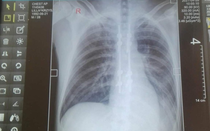 Zbiórka Mpomoc dla Krzysztofa Lilla - zdjęcie główne