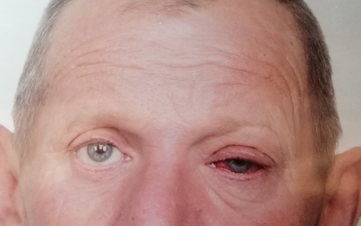 Zbiórka Nowotwór złośliwy oka - zdjęcie główne