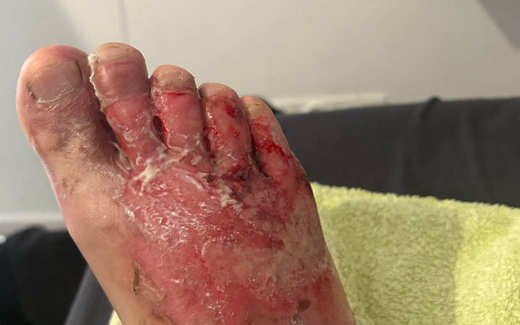 Zbiórka na leczenie po oparzeniu stopy - zdjęcie główne