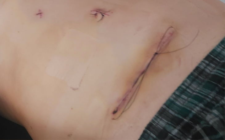 Blizny pooperacyjne na brzuchu, z widocznymi szwami.