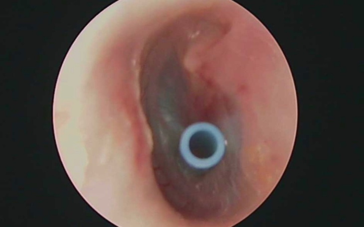 Zbiórka Drenaż uszu - zdjęcie główne