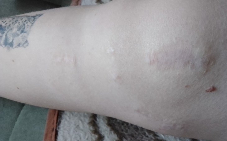 Zblizenie na blizny na nodze, widoczne tatuaże.