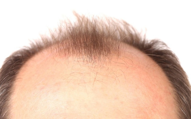 Zbiórka Przeszczep moich włosów - zdjęcie główne