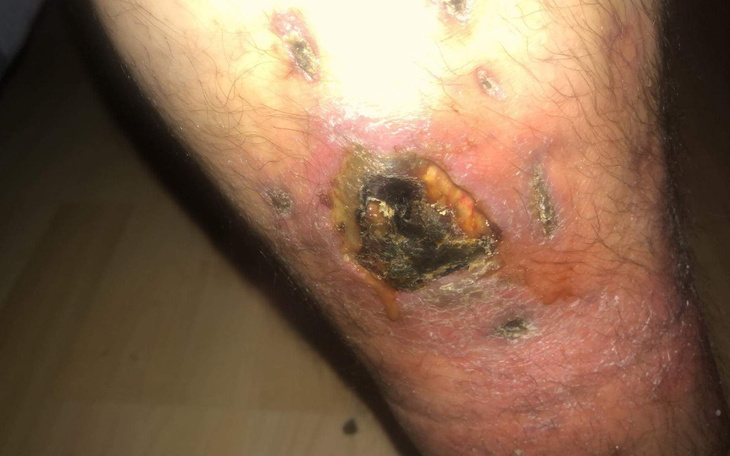 Zbiórka Powrót do zdrowia- Leczenie nogi - zdjęcie główne