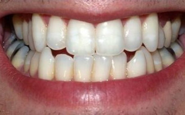 Zbiórka Zbieram na sztuczną szczęke - zdjęcie główne