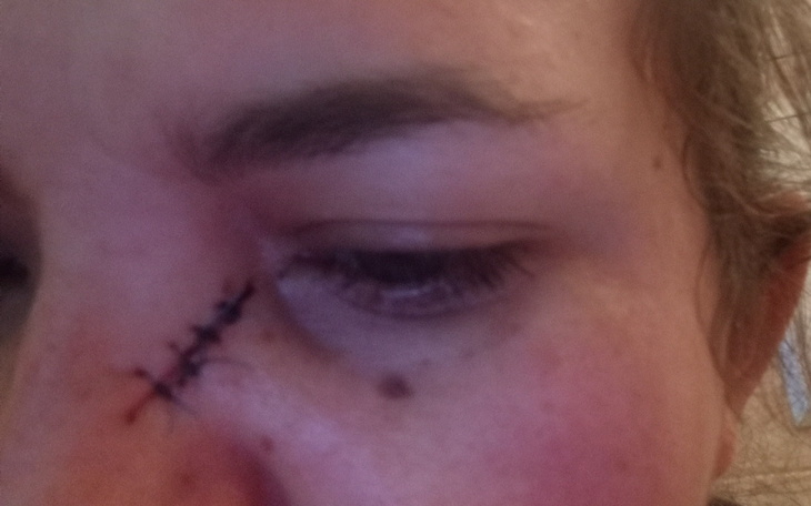Zbliżenie na ranę na twarzy kobiety z szwami.