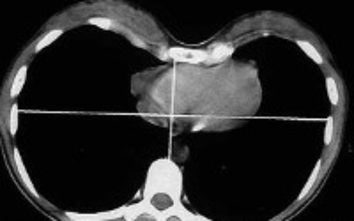 Zbiórka ORTEZA klatki piersiowej - zdjęcie główne