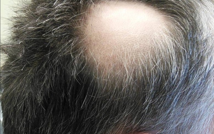 Zbiórka Na transplantacje włosów - zdjęcie główne