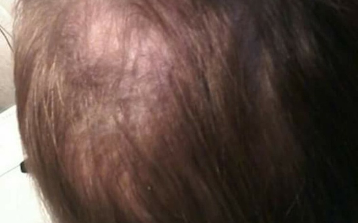 Zbiórka Przeszczep włosów leczenie - zdjęcie główne