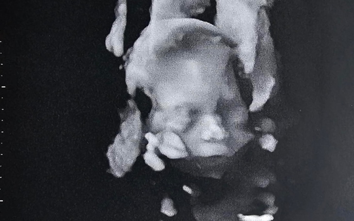 Ultrasonograficzny obrazek płodu w łonie matki.