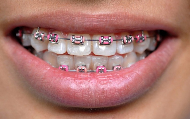 Zbiórka Aparat ortodontyczny dla syna - zdjęcie główne