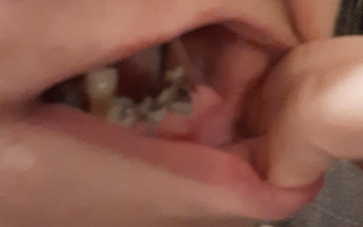 Zbiórka Na leczenie szczęki - zdjęcie główne