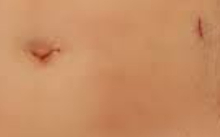 Zbiórka Usuwanie blizn po laparoskopii - zdjęcie główne