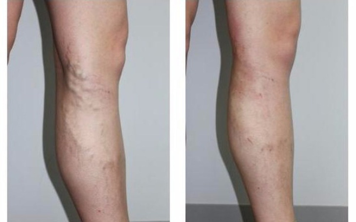 Zbiórka laserowa operacja na żylaki - zdjęcie główne