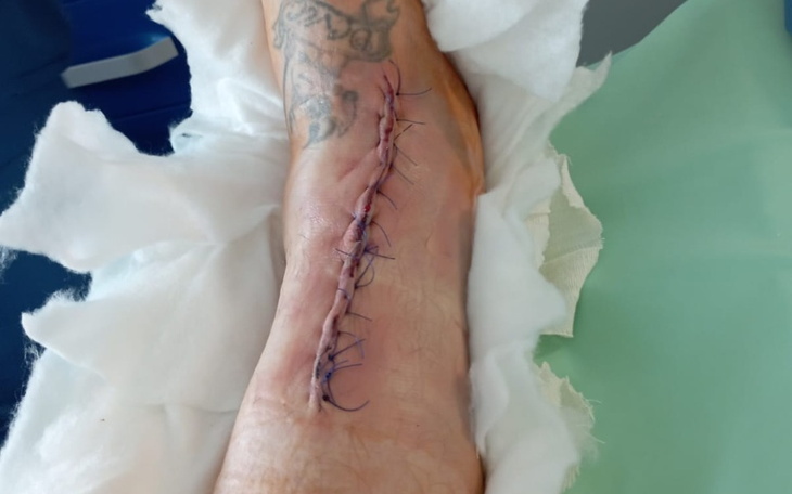 Zszyta rana na nodze po operacji, widoczna szew.