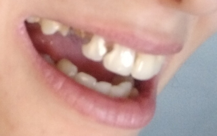 Zbiórka Proteza górna na implantach - zdjęcie główne