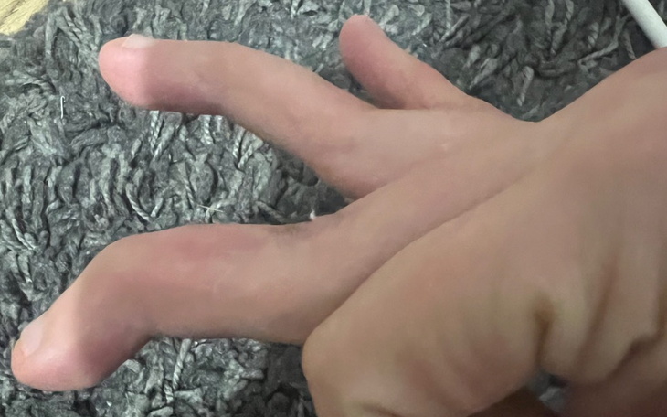 Zbiórka Operacja zdeformowania palców - zdjęcie główne