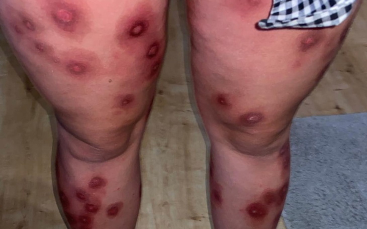 Zbiórka Walka z okropną łuszczycą - zdjęcie główne