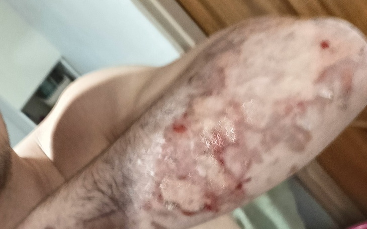 Zbiórka Zbieram na rehabilitację ręki - zdjęcie główne