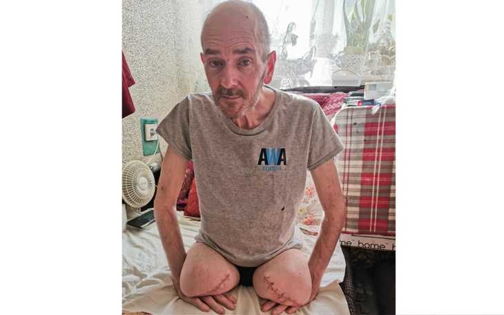 Zbiórka Zbiórka na protezy obu nóg - zdjęcie główne