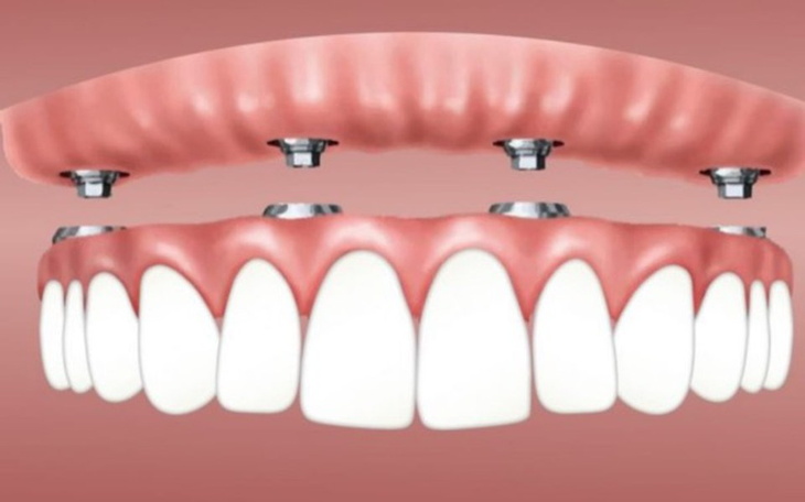 Zbiórka Zbieram na implanty dla dziadka - zdjęcie główne