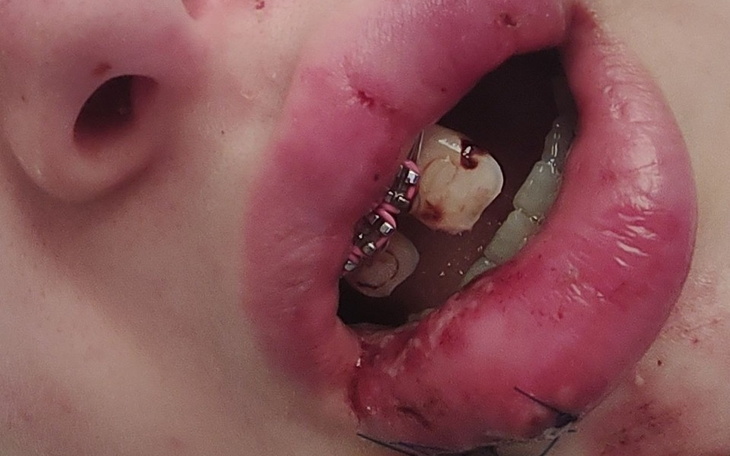 Zbliżenie na usta z aparatami ortodontycznymi i raną.