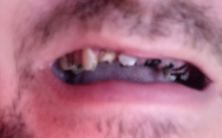 Zbiórka Nowe zęby, leczenie pruchnicy - zdjęcie główne