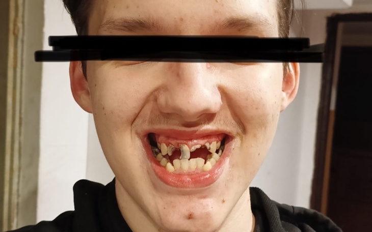 Młody mężczyzna z uszkodzonymi zębami, uśmiechający się.