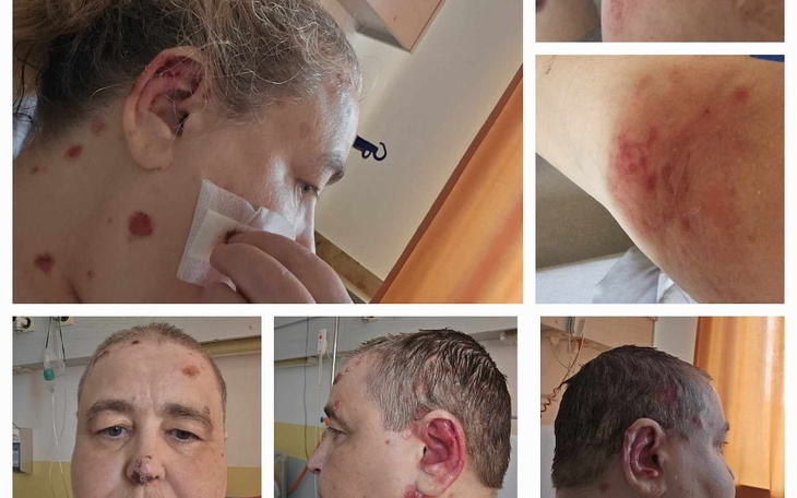 Zbiórka leczenie Pęcherzycy - zdjęcie główne