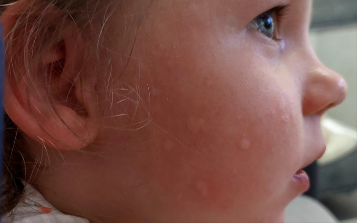 Zbiórka AZS i Silna alergia pokarmowa - zdjęcie główne