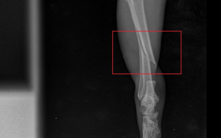 Zdjęcie rentgenowskie nogi z widocznym złamaniem kości.