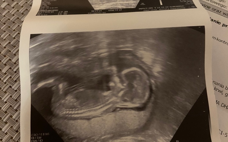 Zbiórka Wsparcie finansowe w ciąży - zdjęcie główne