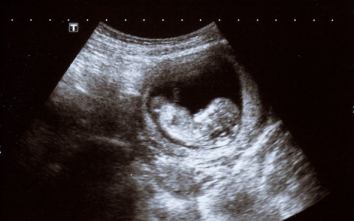 Zbiórka Aborcja w Czechach - zdjęcie główne
