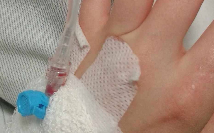 Ręka z wkłuciem dożylanym, przygotowanie do zabiegu.