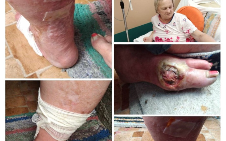 Zbiórka Na protezę nogi mojej mamy - zdjęcie główne